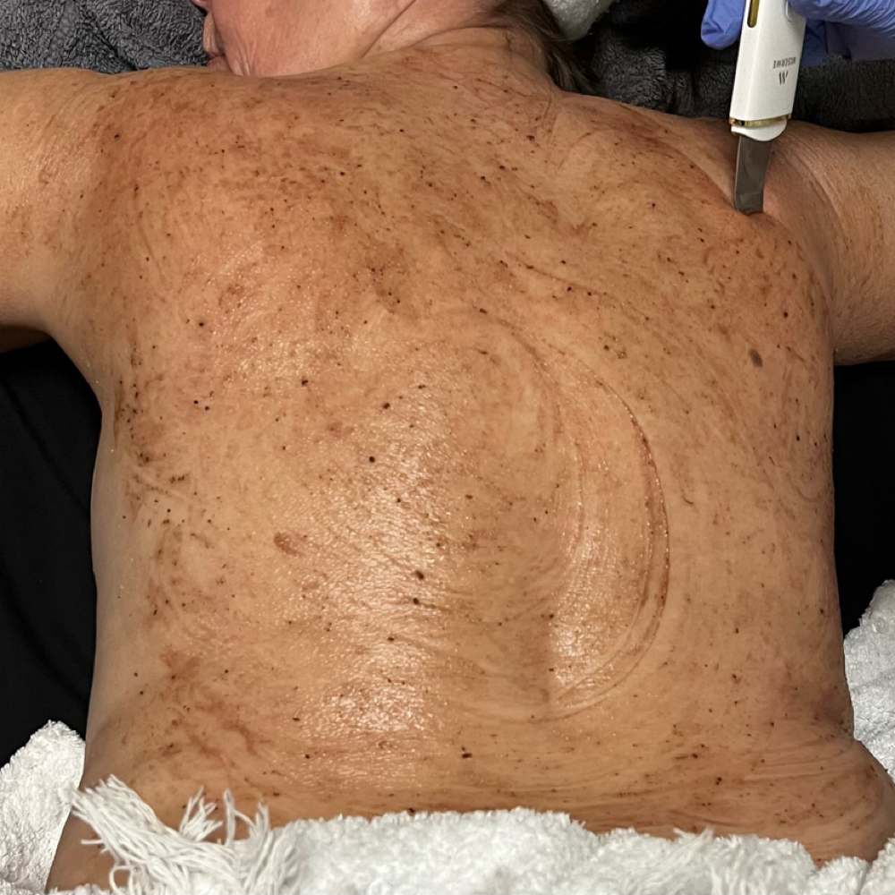 Purifying Back Treatment at Majestik Skincare in Mobile, AL