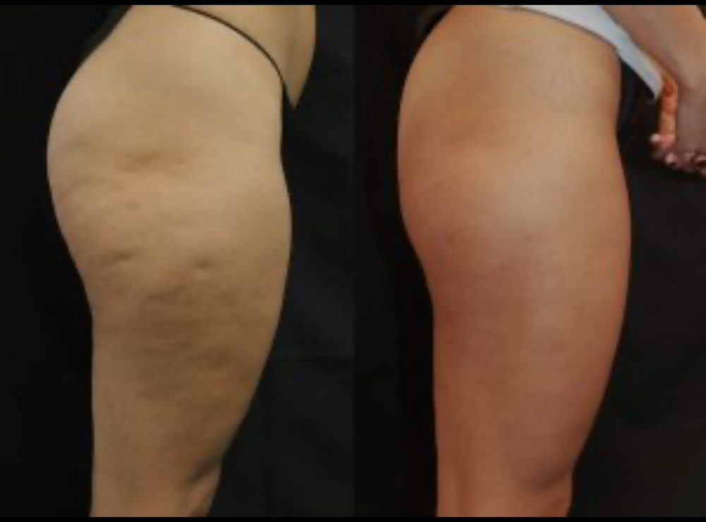 Ultimate Cellulite Treatment