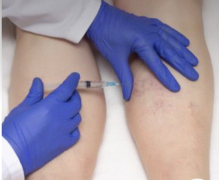 Sclerotherapy