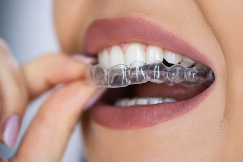 Clear Aligner Treatment at BG Cosmetic in Inglewood, CA