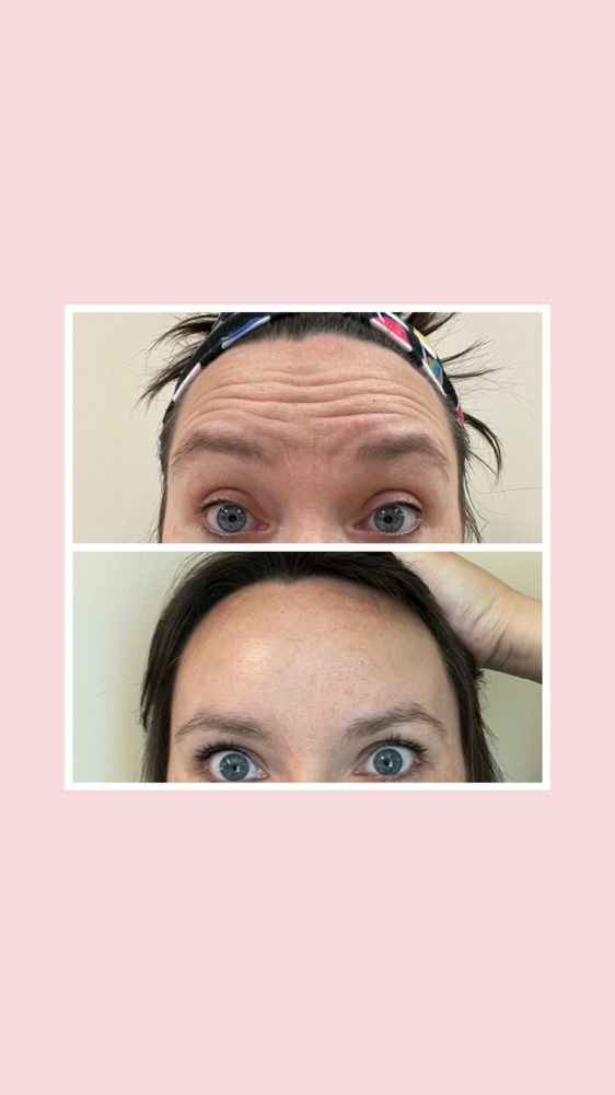 Botox
