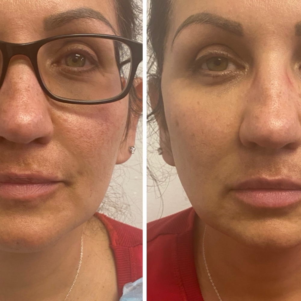 Fautox Facelift at 210 The Body Bar | San Antonio Lux Spray Tans & Body Sculpting in San Antonio, TX