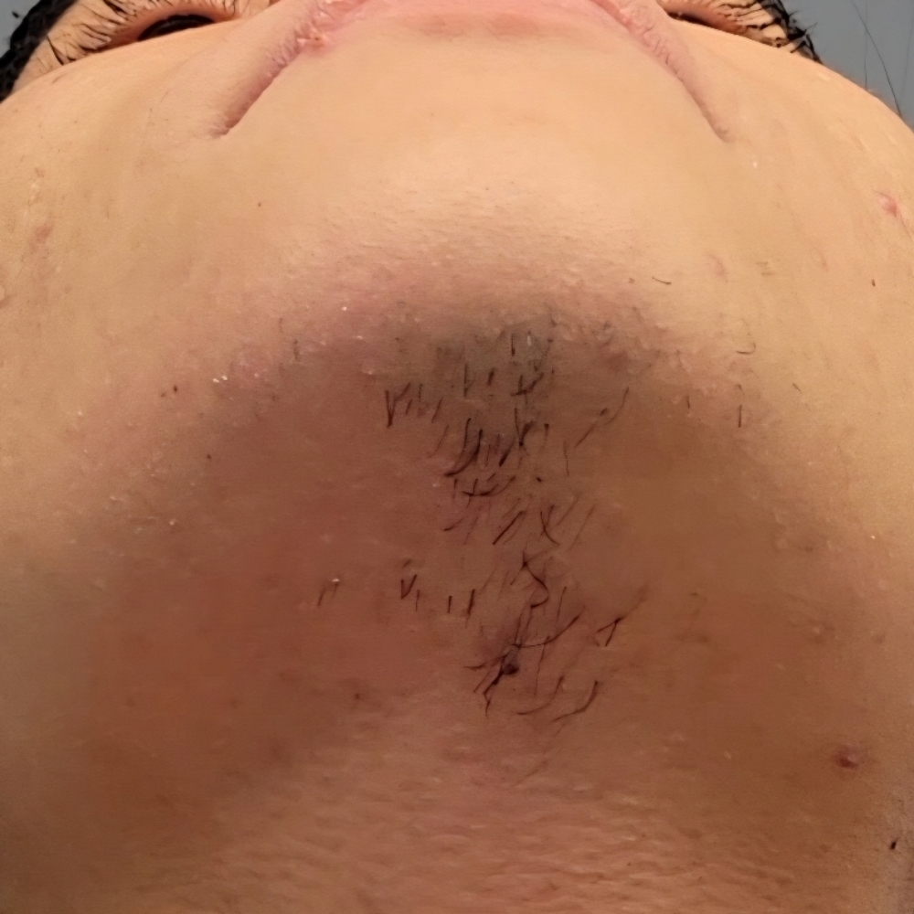 Chin Wax at KMED Spa LLC in East Orange, NJ