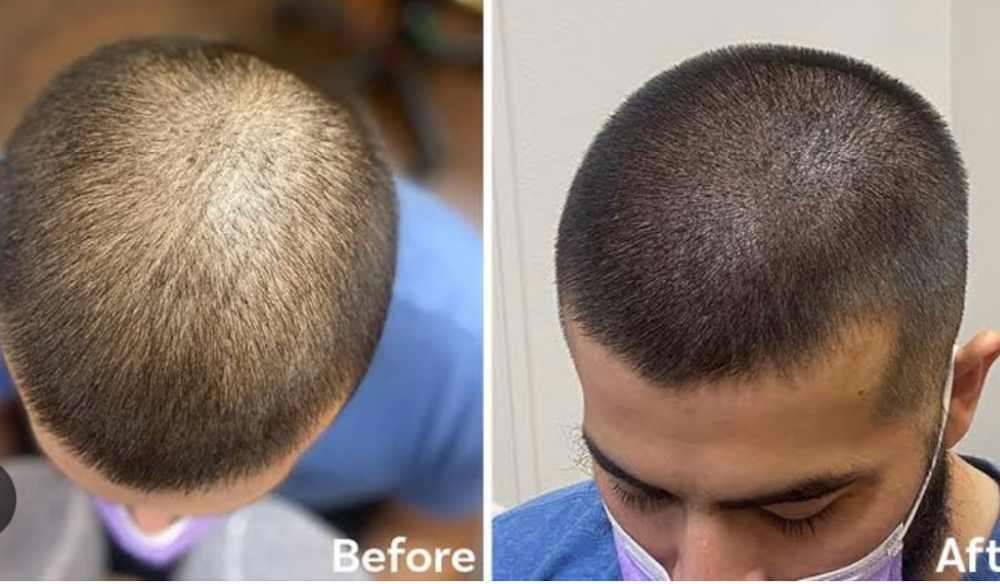 Scalp Micro-Pigmentation at Kalypso Lounge in Texarkana, TX