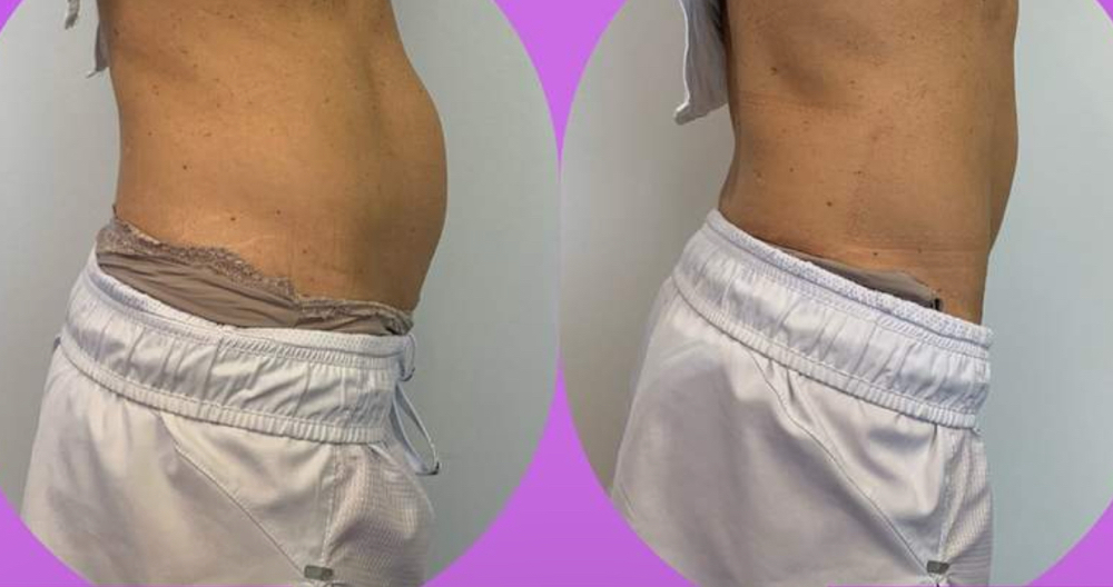 Cryo body sculpting