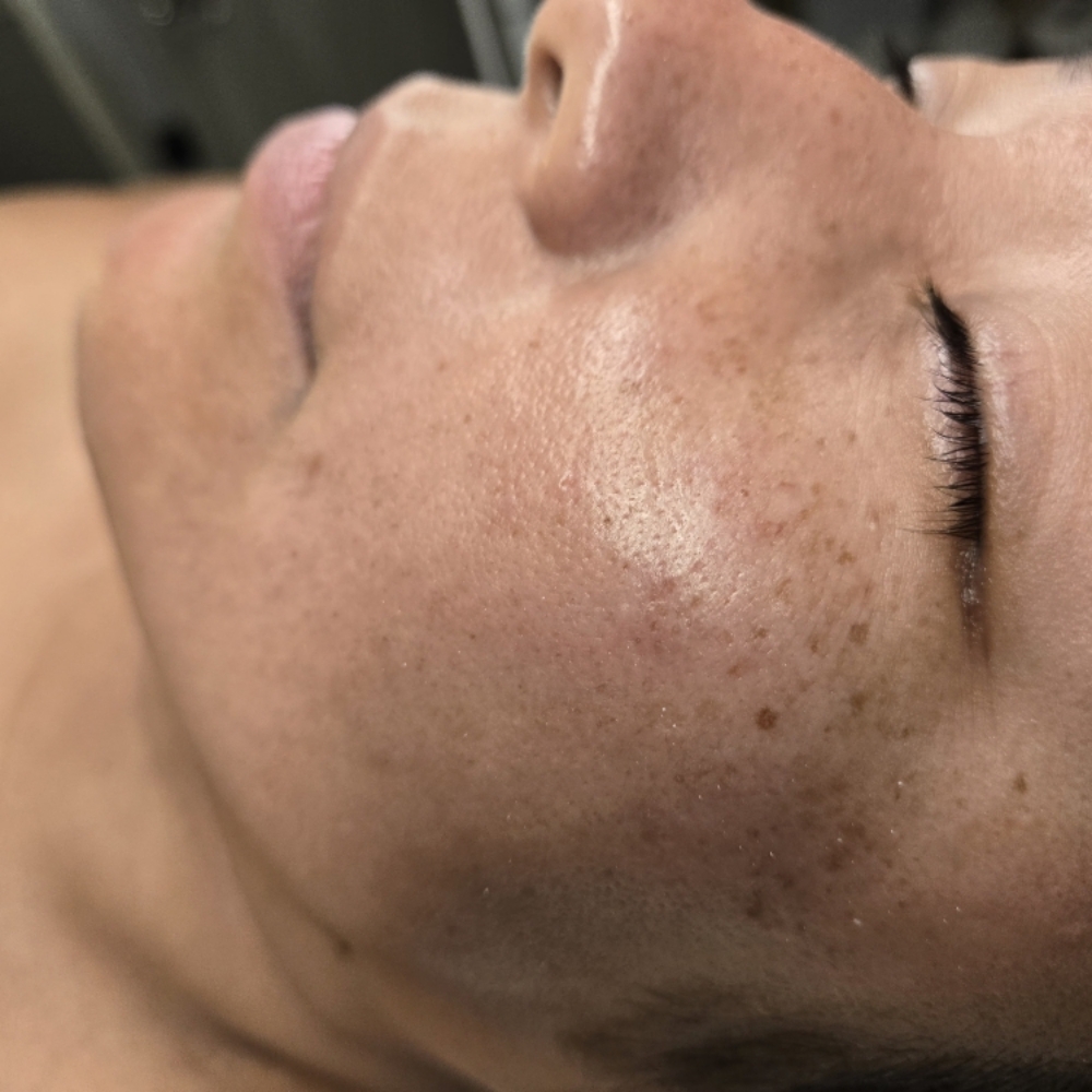 Radiance facial with dermaplaning at Midtown Esthetics in Raleigh, NC