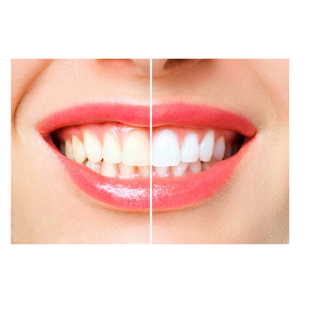 90-minute Teeth Whitening
