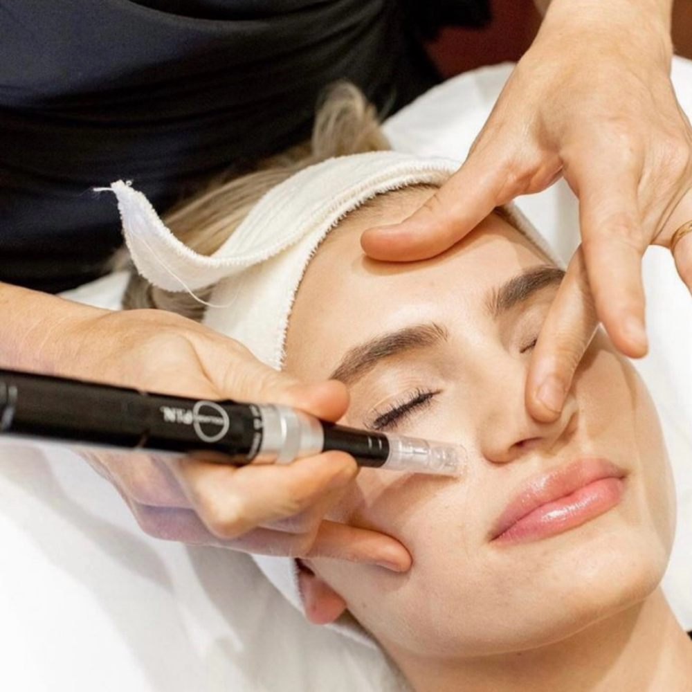 Microneedling (Face, Neck, & Chest) at SOL SKN Aesthetics in Franklin, TN