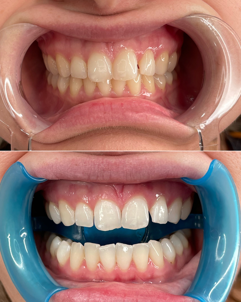 Luxury Teeth Whitening