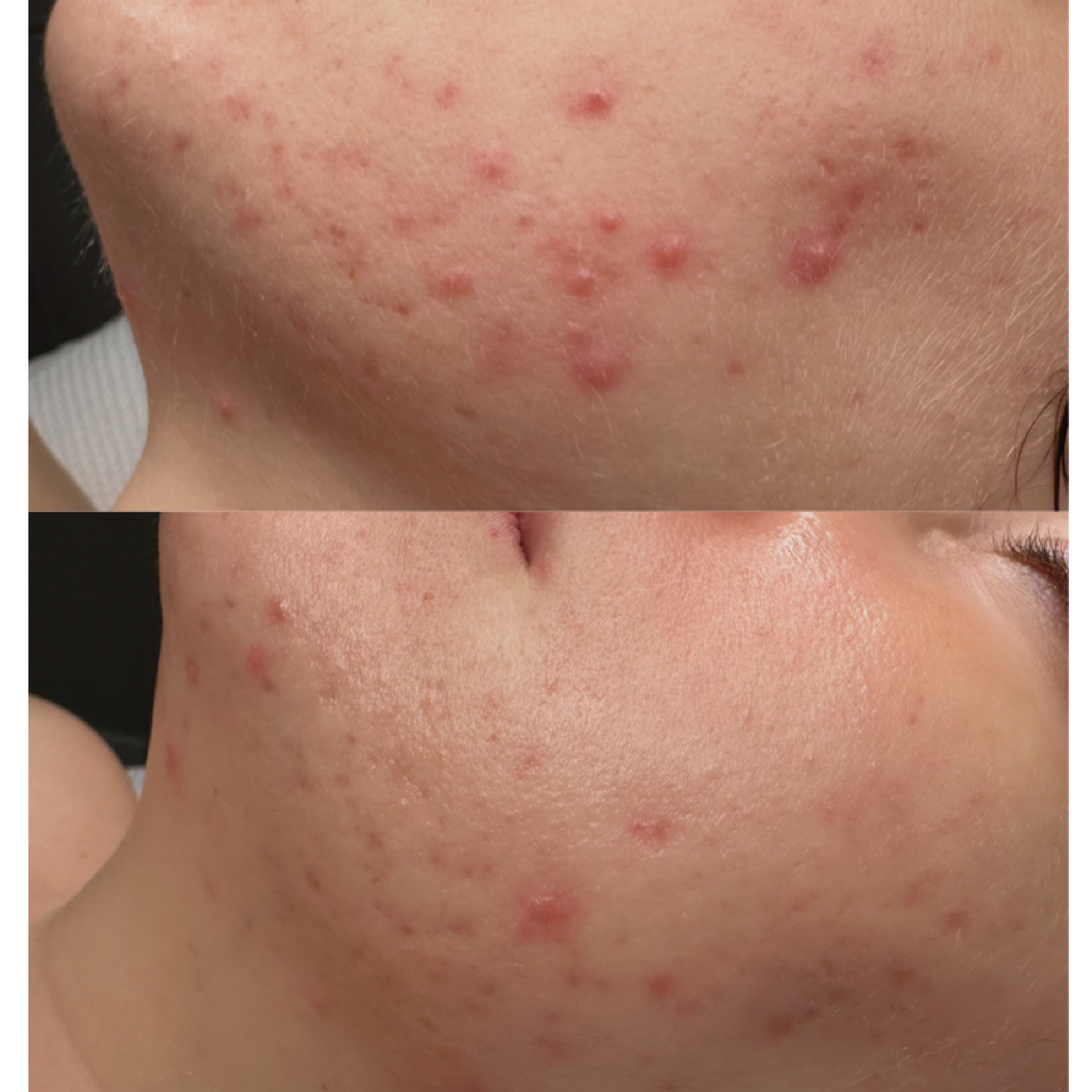 Calm + Clear Journey at The 1213 Skin Studio in Jacksonville, FL