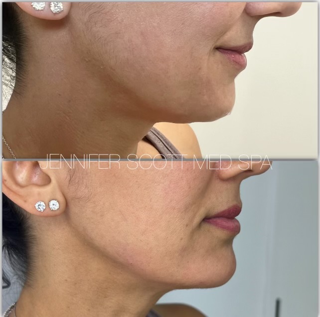 Chin/Jawline Filler