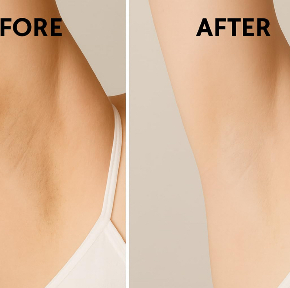 Underarm Uneven Skin ToneCorrection at MediGlow Spa in Spring, TX