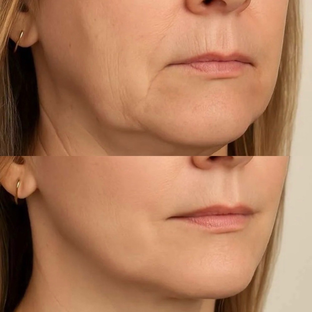 Tox-DAXXIFY Jowls