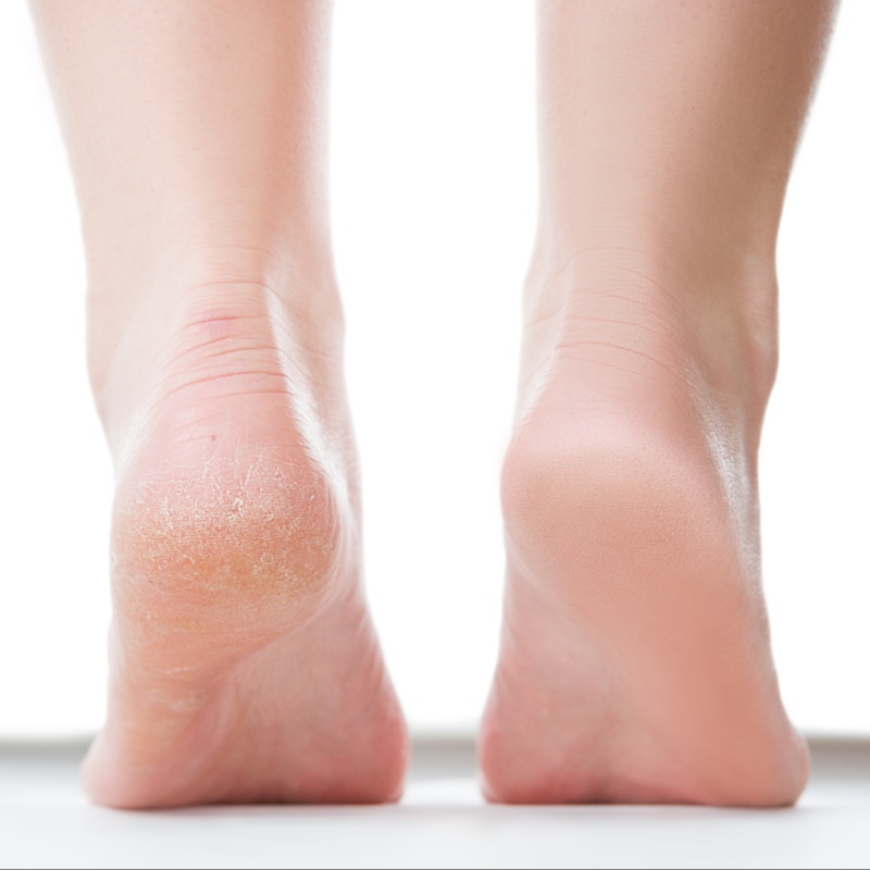 Healthy Heel Restoration (Skin-focu at Meraki FootCare in Dayton, OH