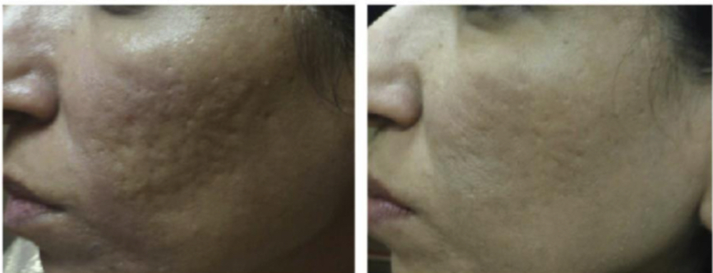 Microneedling