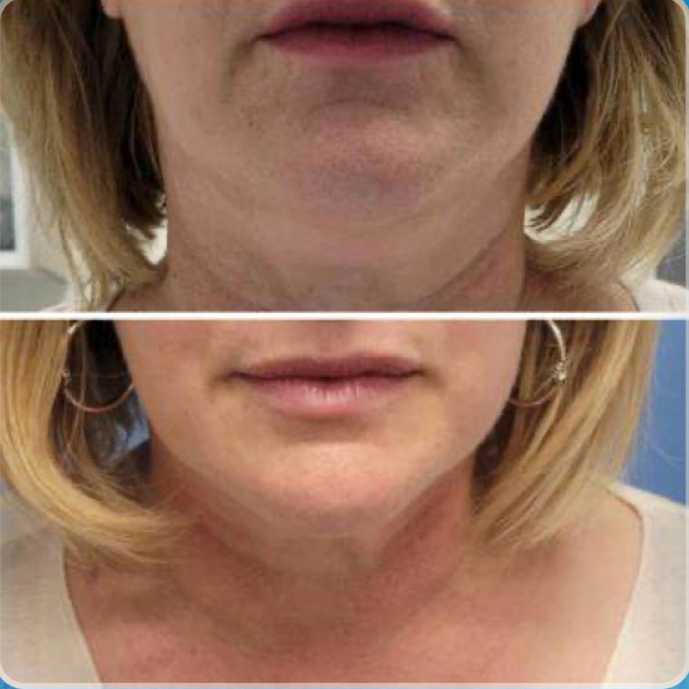 Advance Sculpt & Glow at The Dermal Clinic in Lodi, CA