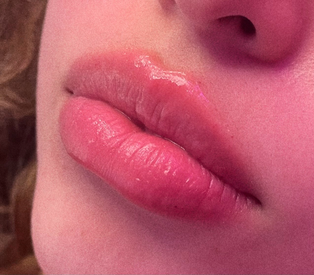Hyapen Needle-Less Lip Filler