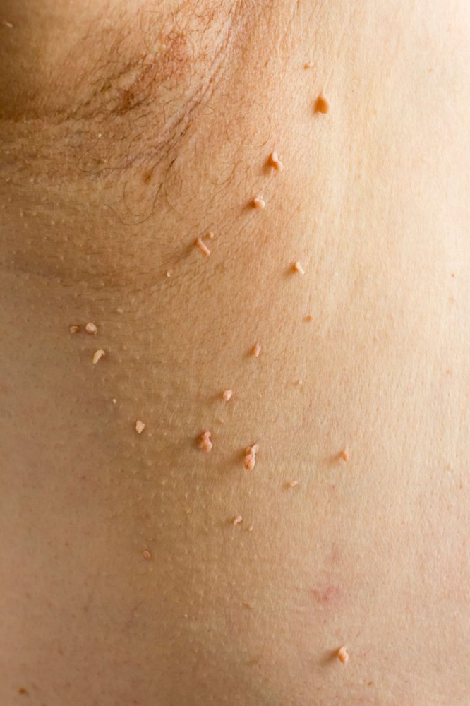 Skin Tag Removal