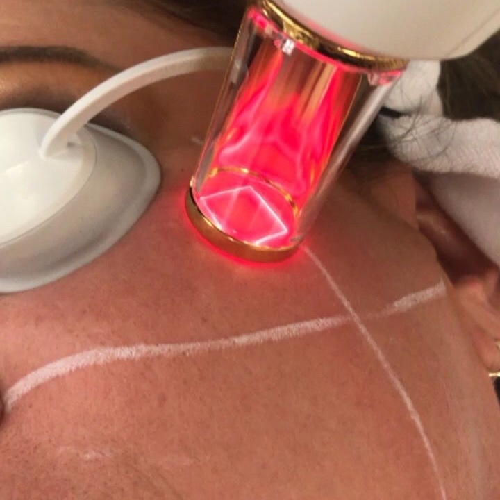 RINOVARE FRAXEL LASER at Remake Beauty Studio San Juan in San Juan, TX