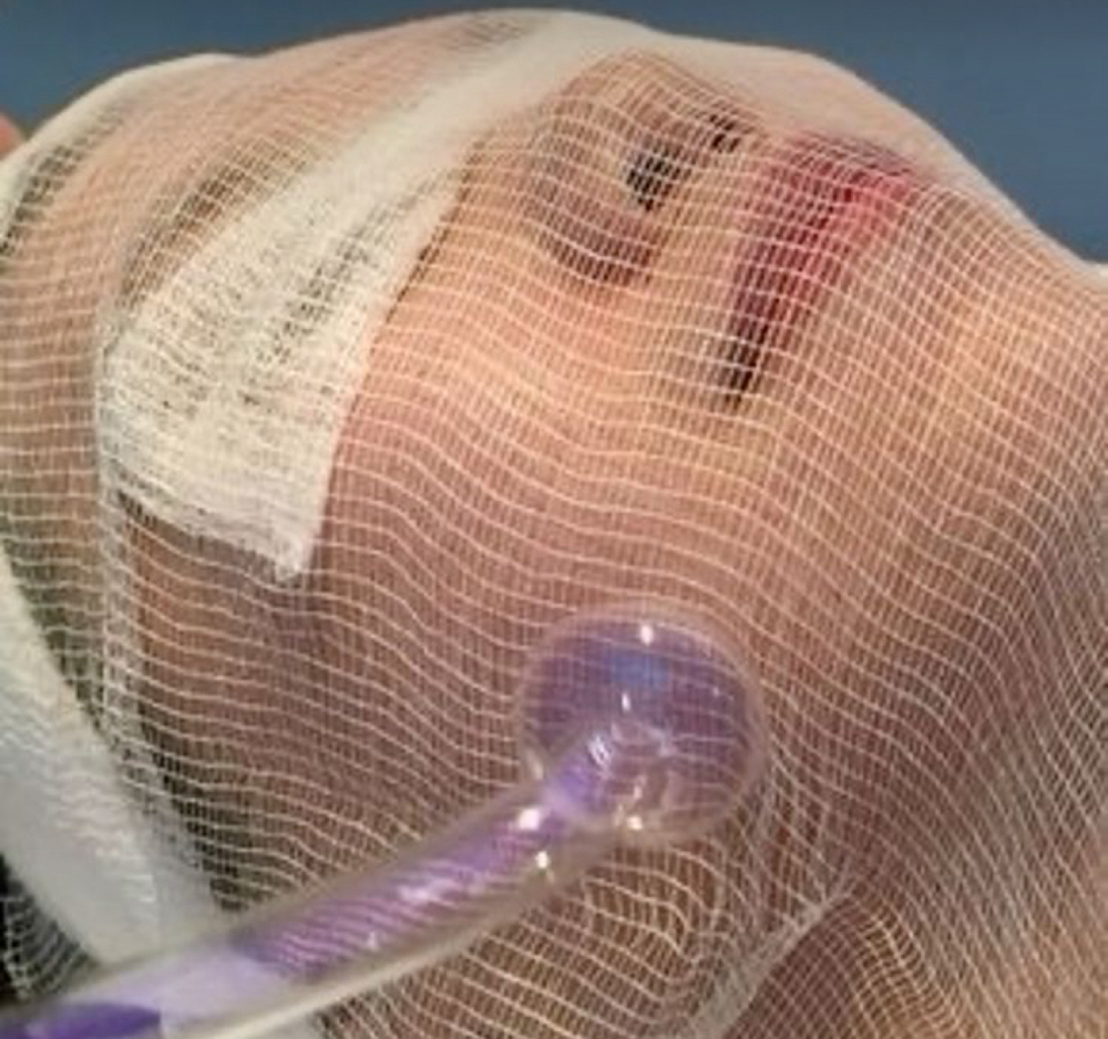 Facials- High Frequency Facial