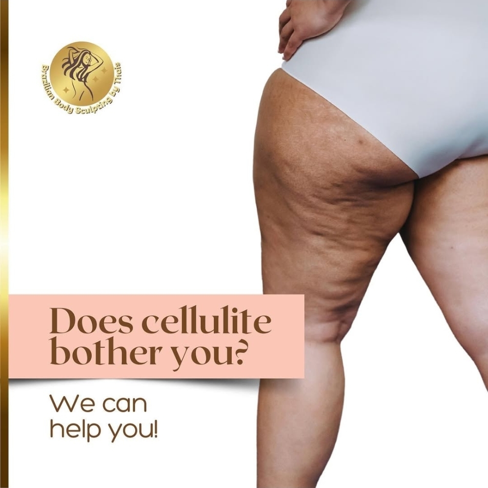 Vellashape Cellulite Treatment