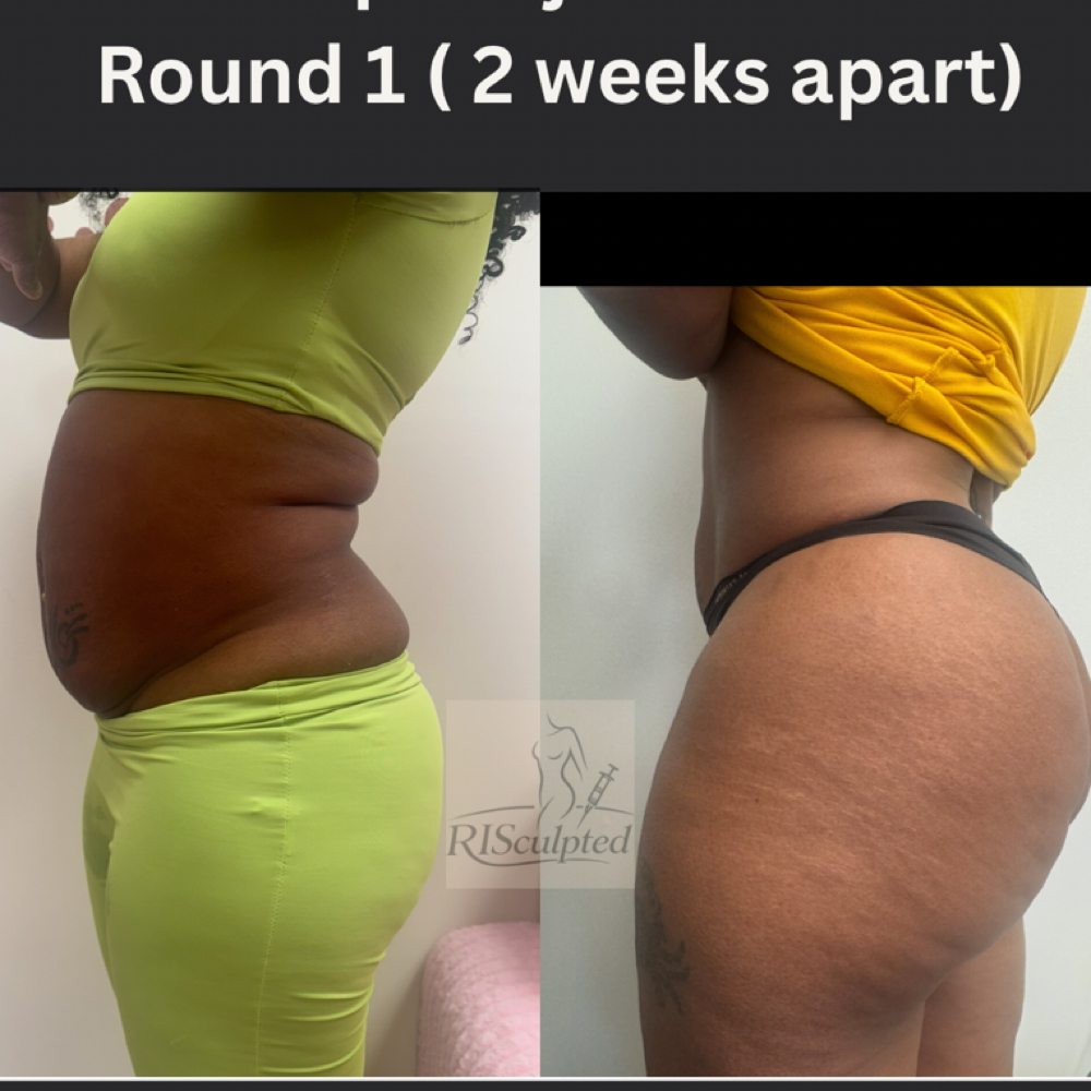 Lipo SINGLE DOSE at RISculpted Aesthetics in Stockbridge, GA