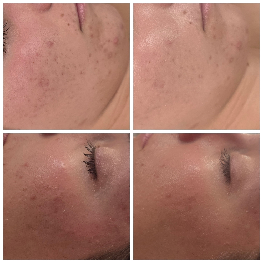 Exosomes Facial at Amber’s Esthetics in Watford City, ND