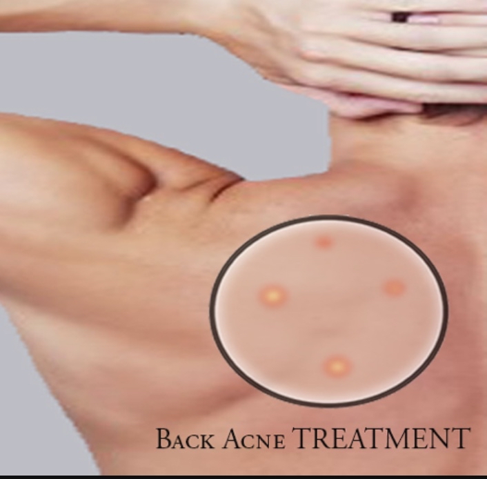 Back Acne Treatment “Bache”