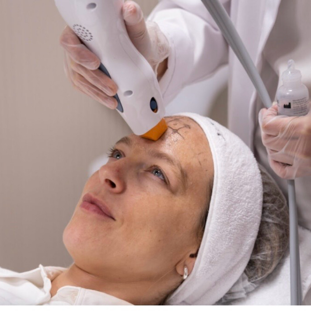4 Sessions Thermage Skin Tightening at Body Beauty Team in Mckinney, TX
