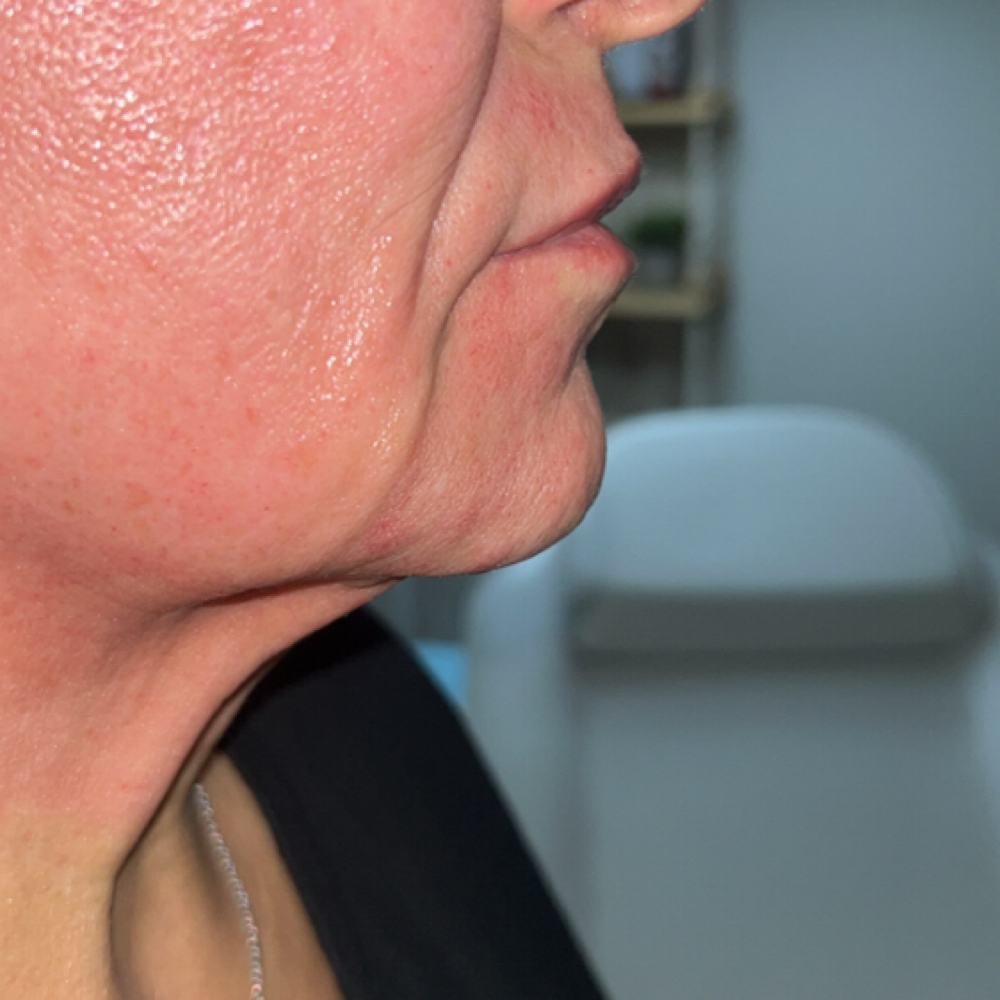 Micro Needling Face And Neck at Kat Marie Aesthetics in Humble, TX