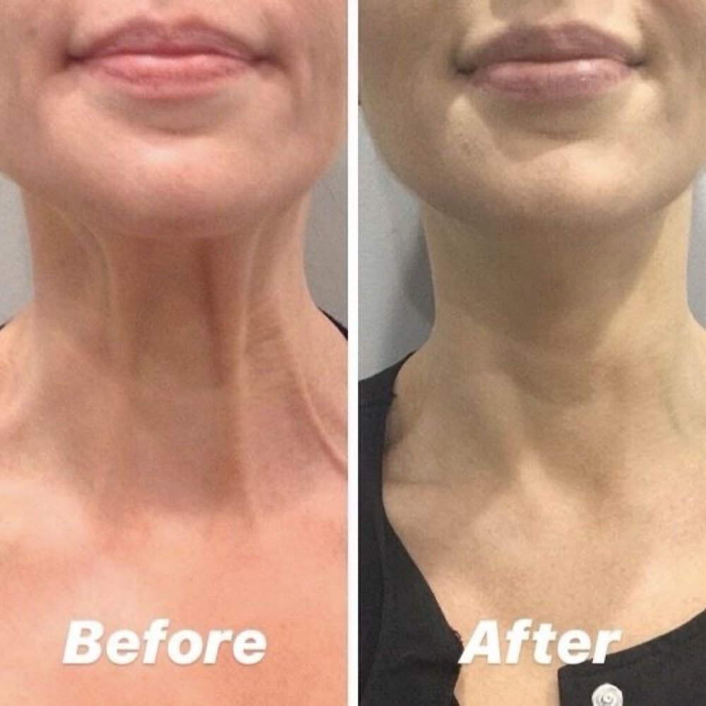 Botox for Neck Bands at La Belle Aesthetics & Wellness in Hellertown, PA