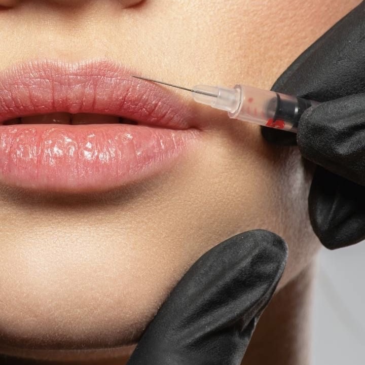 Lip Flip | Gummy Smile Tox