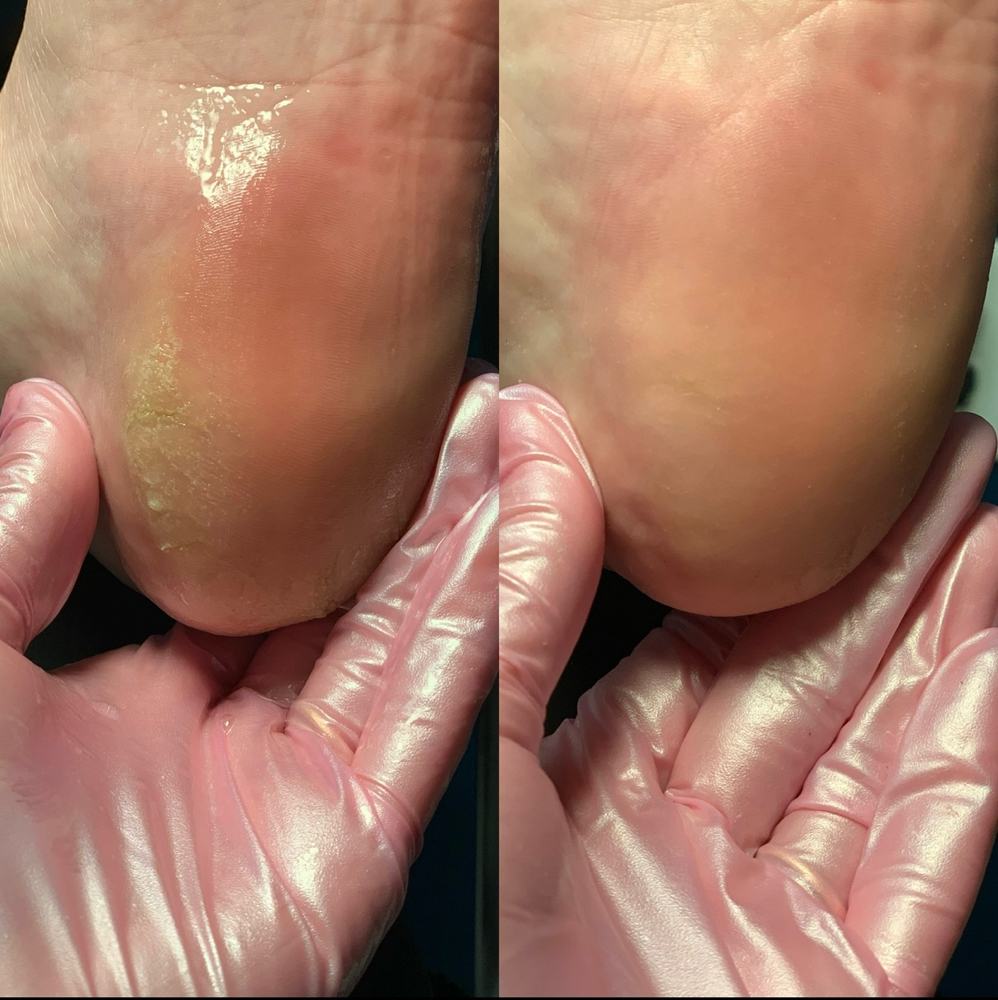 Dry Pedicure
