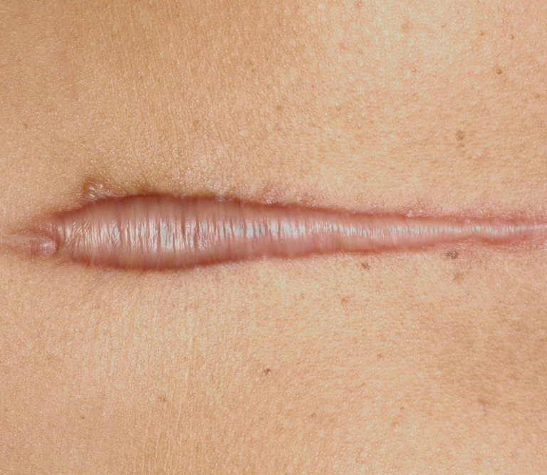 POWER OF LIGHT | KELOID PREP 9Tx