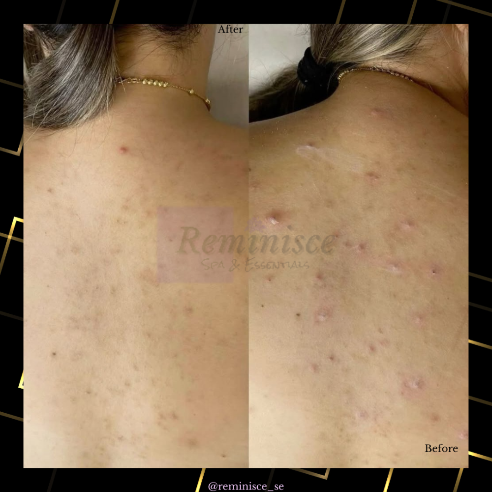 Back Facial