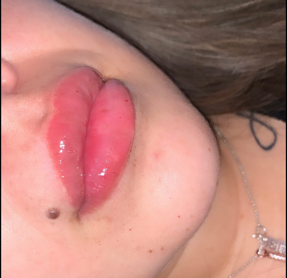 Lip Fillers