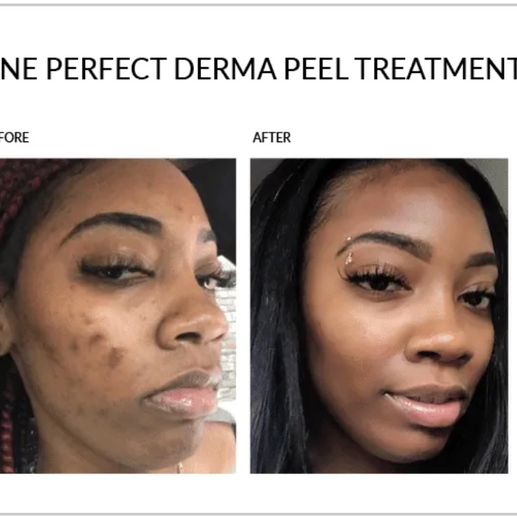 Perfect Derma Peel at A. Shanel Aesthetics in Houston, TX