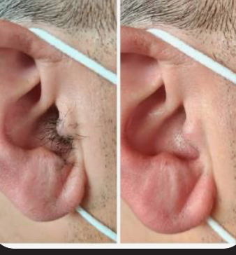 Ear Wax