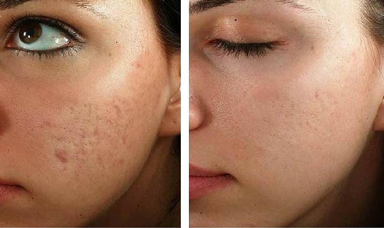 Microneedling