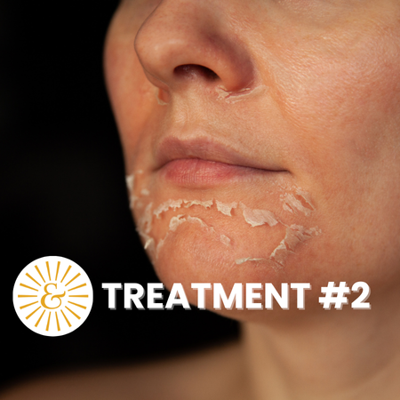 Chemical Exfoliation Series- Txt #2
