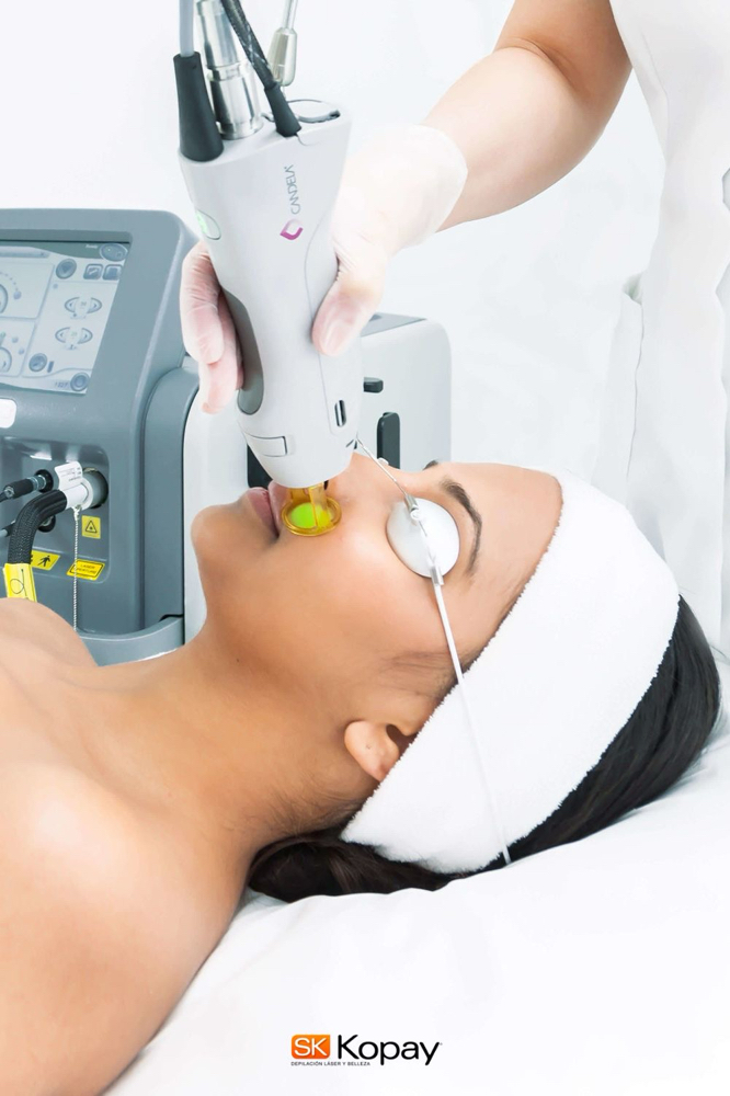 Laser Hair Removal- Women Full Face