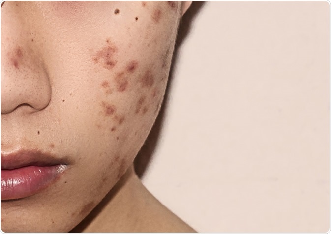 Hyperpigmentation Facial at Skin Love Esthetics in Houston, TX