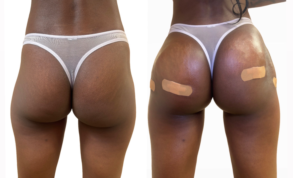 Hip Dip Filler 100mls Each Hip