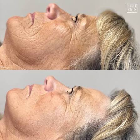 Peptide Enzyme Facial