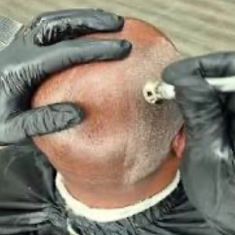 Bald Head Microdermabrasion Facial at Forever Amor Massage & Spa By Aneashia in Monroe, LA