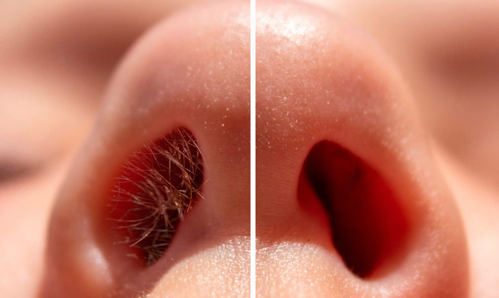 NOSTRILS (fosas nasales)