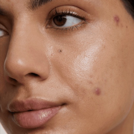 Acne targeted facial at Spa Ravine Med Aesthetics in wayne, NJ