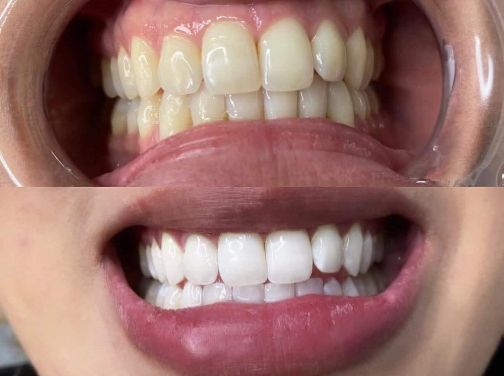 Teeth Whitening