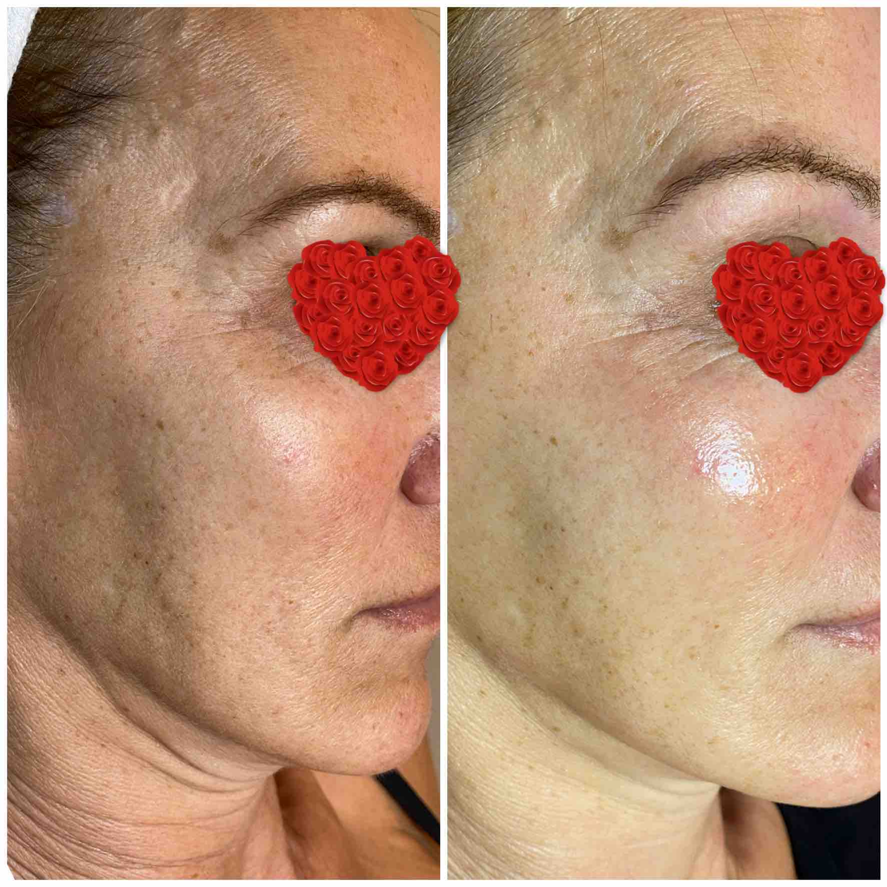 StemCell Microneedling