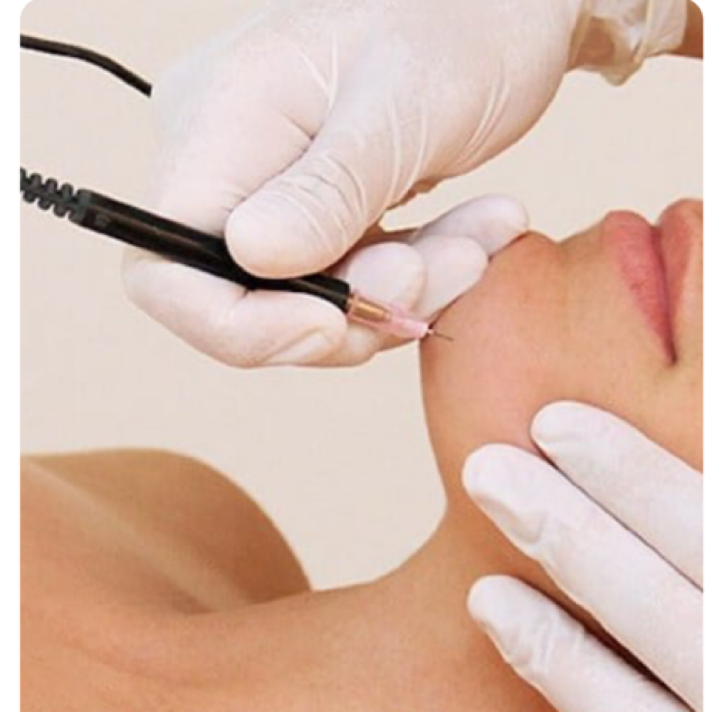 Electrolysis at Aura Electrolysis | Laser | Threading in Ashland, MA